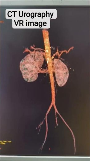 CT Urography VR image #anatomy #viral #radiographer