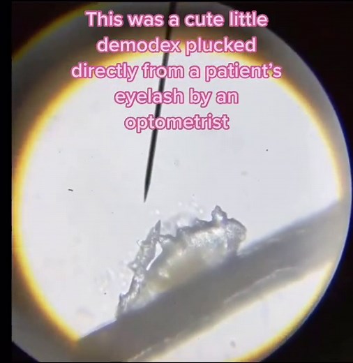 Demodex Mites in Lashes: What You Need to Know