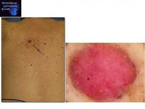 Nevoid Melanoma - Dr. Caterina Longo