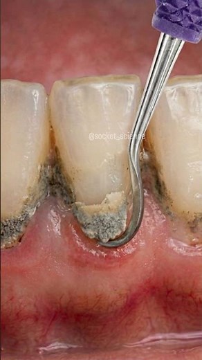 The Art of Debridement: Breaking the Calculus Bridge 🦷✨
