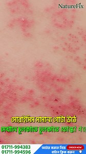 1.5M views · 37K reactions | ⛔সকল প্রকার চুলকানি ও এলার্জির জীবাণু...