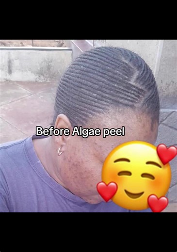 Transform Your Skin with Algae Peel Treatments