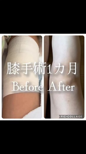 術後1カ月を過ぎて、松葉杖卒業いたしました👩‍🎓 歩行はまだぎこちないんだけど（細かく言えば大腿四頭筋の使い方がまだまだ）自分の足で手に荷物を持って歩けることが嬉しいの☺️ という事で、手術から1カ月を自分なりにまとめてみました 😤😤😤 あっという間だけど、振り返ると長かった… ヨガ練習は膝に負担がかからないものならオッケーとDr.から言われたので、ぼちぼち始めます💪✨ ちょうどそんな時にパーソナルで逆転を受けたいという生徒さんからご連絡があったので、パーソナルレッスンは柔軟性向上と逆転（ピンチャまで）を再開しようかなぁと考えています。 逆転のパーソナルはハンドだとジャンプが入るので、まだ膝への負担を考えるとピンチャまでとなります。 戻りや着地はデモができませんのでご了承くださいね🥹🙏 グループレッスンやイベント、オンラインレッスンも膝の様子を見ながらとなり、まだ未定です🙏 よろしくお願い致します🥹🙏✨ ============================== 180日後に復帰するヨガインストラクター 膝のやっちゃう→オペ（半月板縫合術）→リハビリ（いまここ）