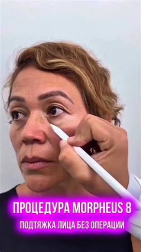 Косметология | Капельницы | Пересадка волос | Гинекология on Instagram: "Получи вторую молодость с Morpheus8 🔥 ЭФФЕКТ Morpheus8 - это инновационная радиочастотная микронидлинг-процедура безоперационной подтяжки лица. ✅ Без хирургии, всего за 1 сеанс, и ты выглядишь на 10 лет моложе. ✅ Преимущества: • Кожа гладкая, плотная и упругая • Подтяжка контуров лица • Уменьшает дряблость и морщины • Сужает поры • Свежий, молодой вид • Минимальное восстановление Для подробностей пишите внизу +"