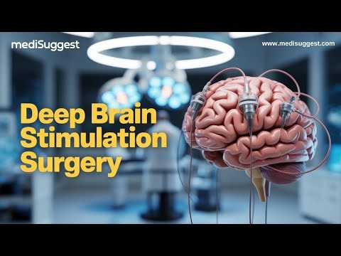 Deep Brain Stimulation (DBS) Explained 🧠 Advanced Treatment for Movement Disorders