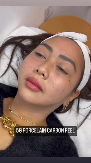 163K views · 857 reactions | 5G Porcelain Carbon Peel for Skin Rejuvenation with Instant Brightening Results. Effectively targets acne, acne marks, enlarge pores, wrinkles, fine lines, reduce oily skin, and pigmentations. Achieve a Brighter and Radiant Complexion Skin Instantly! Book your appointment now! #fyp #carbonpeel #5gporcelainlaser #savougeaesthetics #AlagangSavouge #yourmostpaSAVOUGElookbeginshere | Savouge Aesthetics Pampanga | Facebook