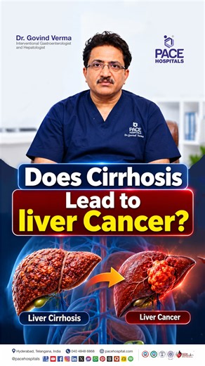 Does Cirrhosis Lead to Liver Cancer? | Liver Cirrhosis Complications