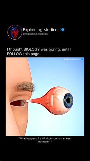 Medical | Health | Anatomy on Instagram: "What happens if a blind person has an eye transplant is very different from what most people imagine, because doctors cannot transplant a full working eye like a kidney or heart, and blindness usually comes from damage to the optic nerve or the retina, not the eyeball itself. The optic nerve is like a cable carrying millions of visual signals from the eye to the brain, and once it is damaged—by trauma, glaucoma, or genetic disease—it cannot reconnect or