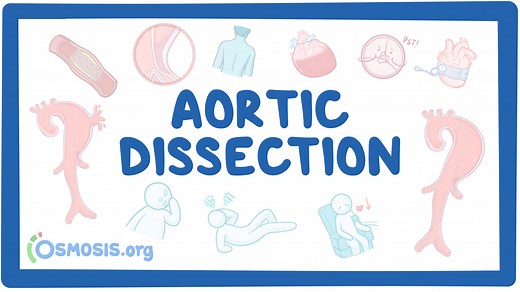 Aortic dissection: Video & Meaning | Osmosis