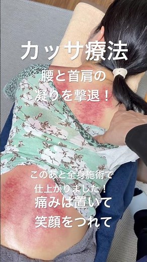 [For neck and shoulder stiffness and lower back pain!] Gua Sha therapy!