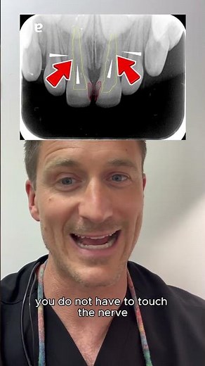 Front Teeth with Cavity Transformed Using Crowns