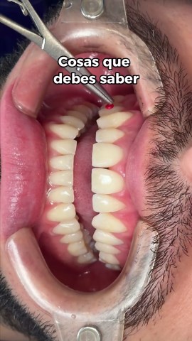 ¿Tienes espacios entre tus dientes? 👀🦷 Entonces tienes que saber esto ✨ Los botones estéticos pueden ayudarte a cerrar esos pequeños espacios de forma sutil, cómoda y natural 😮‍💨. Un tratamiento sencillo, pero con cambios que hacen mucha diferencia 👀 Comenta “botones” y te contamos toda la información 💬 👩‍⚕️ Dra. Diana Burbano Ortodoncista. 📲 ( 57) 316 7318237. 🏢 Edificio Gaia. 📍 Cra. 17 #89-31 Bogotá, Colombia. #odontologo #bogota #diseñodesonrisa #sonrisa #botonesesteticos #orthodont