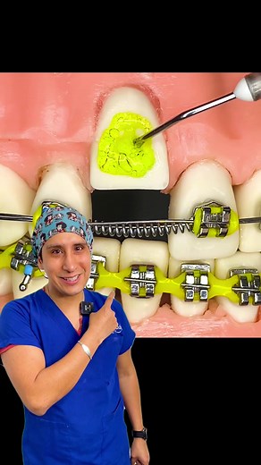 Cómo colocar brackets en tres pasos sencillos