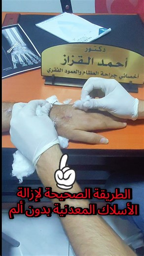 إزالة الأسلاك المعدنية K-Wire بطريقة صحيحة بدون بنج وبدون الم #youtubeshorts #جراحة_العظام #اكسبلور