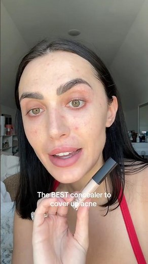 The BEST concealer to cover acne! #acne #acneproneskin #acnetips #acnemakeup #makeup #makeuptips