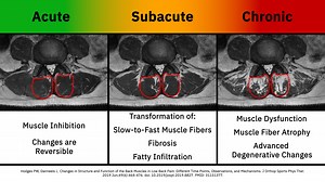 Multifidus Muscle Atrophy Simulation Over Time