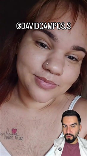 HIRSUTISM