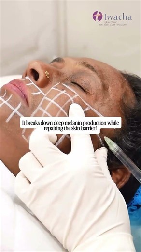 The Secret Treatment for Stubborn Melasma You Haven’t Tried Yet!