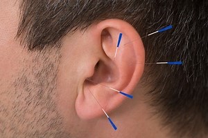 An Introduction to Auricular Acupuncture for Pain Management »  Pain Assessment and Management Initiative » College of Medicine - Jacksonville » University of Florida