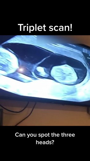 Identical Triplets Ultrasound Scan Comparison