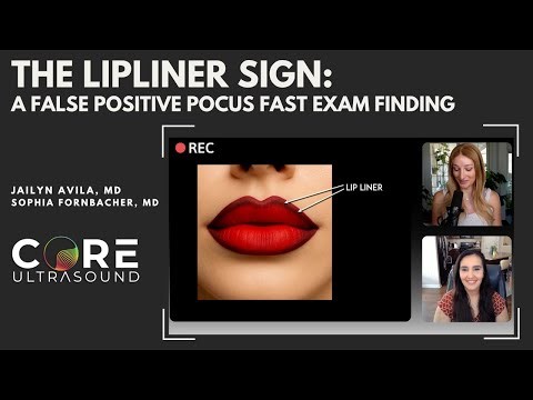 Exploring the Lip Liner Sign: Avoiding False Positives in FAST Examinations