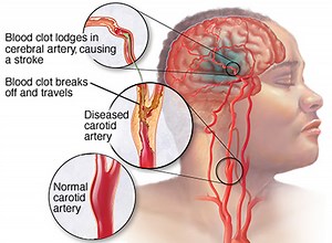 Apoplexy | Definition, Types and Examples