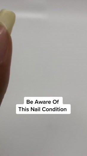 Brown Nail Stripe? See Your Doctor ASAP