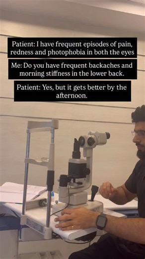 This young patient presented with frequent pain, redness and photophobia in both the eyes from last 2 years. Eye examination revealed acute anterior uveitis with 4 cells and marked flare. Systemic history revealed morning stiffness and lower back pains from last 4 years. Further investigations revealed HLA B27 to be positive. The patient was an untreated case of ankylosing spondylitis and was referred to rheumatologist for further management. ---------- The patient was started on topical steroid