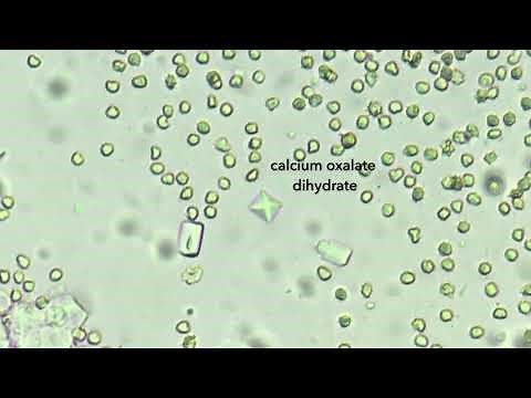 Calcium oxalate dihydrate crystals in urine