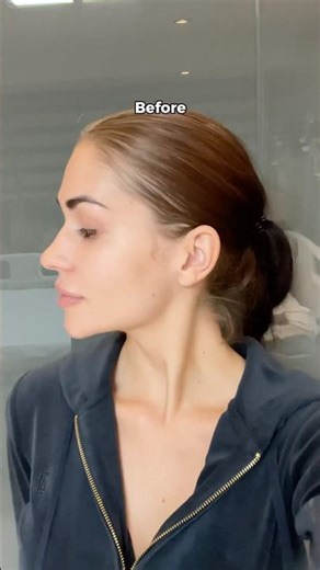 Rhinoplasty before after #shorts #beforeandafter