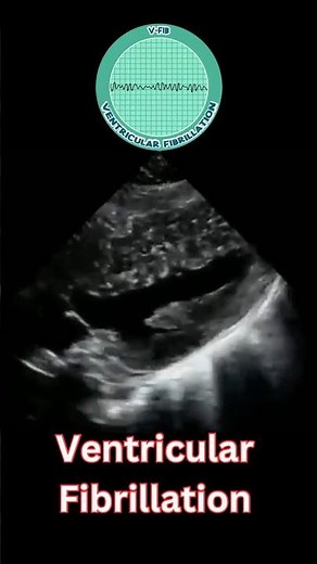 Ventricular Fibrillation (V Fib) on Echo – A Deadly Arrhythmia Leading to Cardiac Arrest