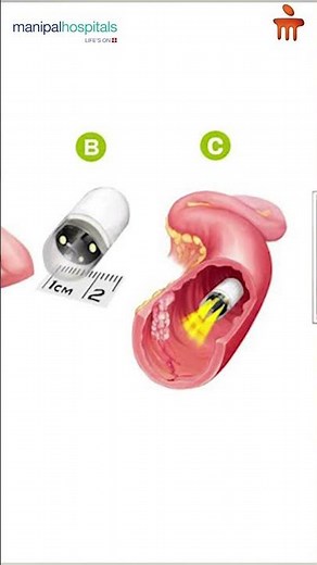 Capsule Endoscopy Explained | Dr. Puneet B S, Manipal Hospital Malleshwaram