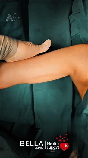 #armlifting Turkey 2026: Bella Clinic Best Cost, Brachioplasty Before & After