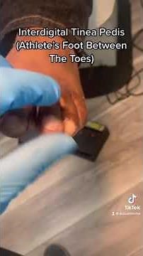 Interdigital Tinea Pedis: Athlete’s Foot Between The Toes - YouTube Shorts