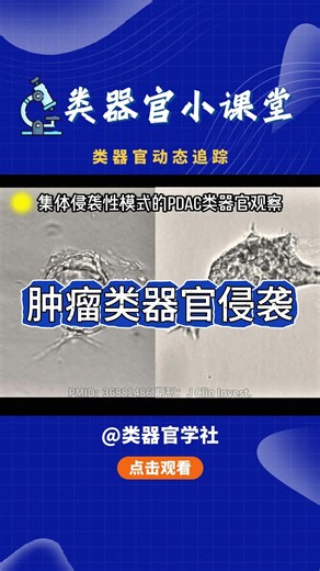 集体侵袭性模式的PDAC类器官观察