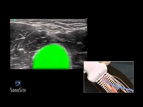 How to: Ultrasound Guided Peripheral Inserted Venous Catheter 3D Video