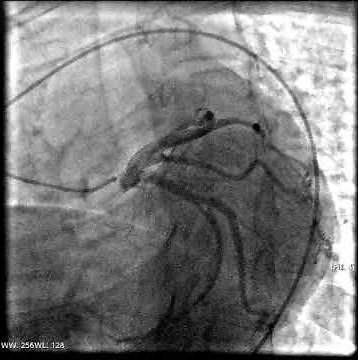 Coronary angiography video. Operation.