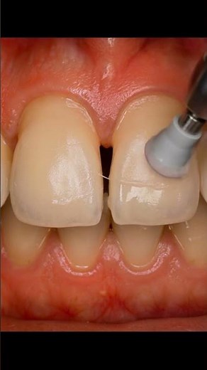 Preparing front teeth for veneers