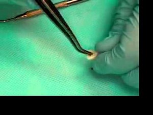 Video 13 Placeing Cavit