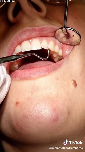 American tooth numbering system #tooth #dental #zahnarzt #lernenmittiktok #fürdich #fyp #foryoupage #dochelka #dentist