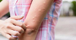 Urticaire cholinergique : causes, symptômes, traitement