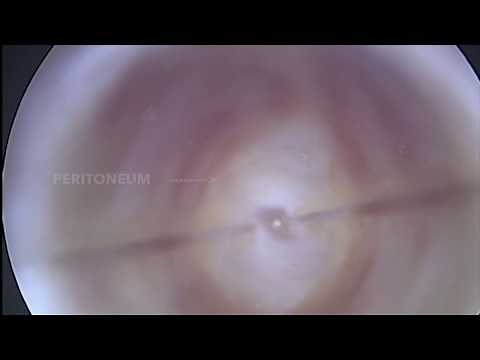 Optical trocar insertion (visiport/optiview) by Dr Ajay Aggarwal