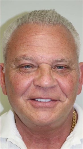 The Art of Pre-Surgical Drawings for a Facelift & Necklift 🎨 #shorts