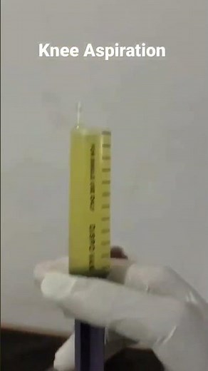 "Learn how to perform knee aspiration safely and effectively to relieve joint swelling and analyze s