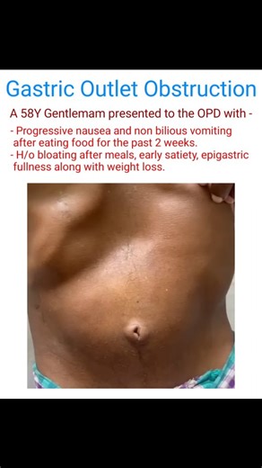Dr Harsh Duhan on Instagram: "⏩️ Gastric Outlet Obstruction (GOO): A Surgical Perspective⠀ ✅️ Basics⠀ Gastric outlet obstruction = mechanical blockage at pylorus or proximal duodenum. Can be congenital/acquired, acute/chronic.⠀ ✅️ Etiology & Causes⠀ Acquired: Malignancy: distal gastric cancer, pancreatic head tumor (most common in adults). Peptic ulcer disease (PUD): inflammation & fibrosis. Chronic pancreatitis, caustic ingestion, Crohn’s (rare upper GI involvement).⠀ Congenital: Pyloric stenos
