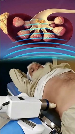 How to remove kidney stones by sound