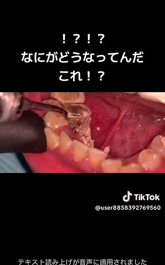 歯石除去のプロセスと歯科医師の「あるある」