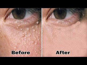 Milia Treatment - 3 Weeks To Remove Milia and White Bumps Under Eyes By Home Remedies| Health 24H