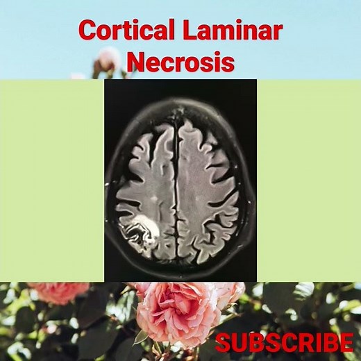 Cortical Laminar Necrosis - Neuro Radiology - Review