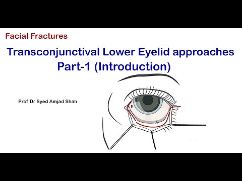Transconjunctival Lower Eyelid approaches | Part-I | Oral Maxillofacial Surgery | Syed Amjad Shah